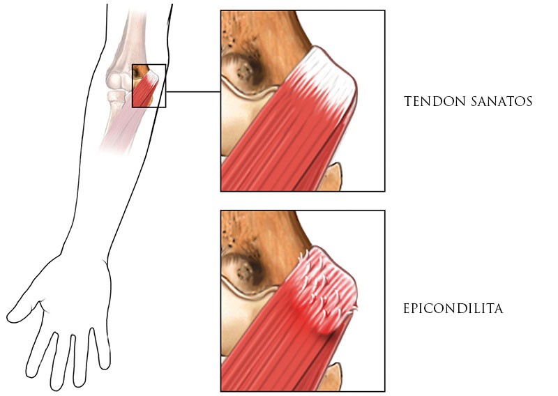 epicondilita durere in cot tendon